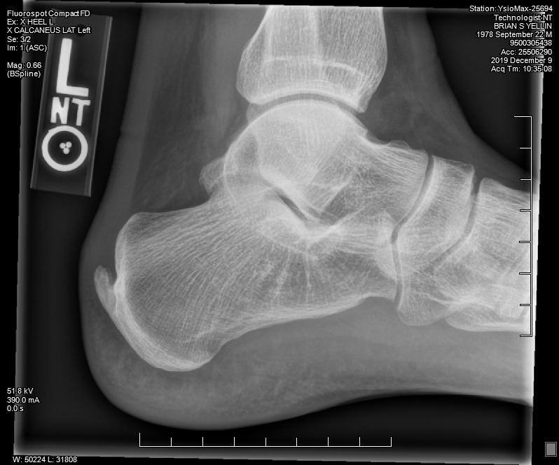 X-ray of Brian's heel